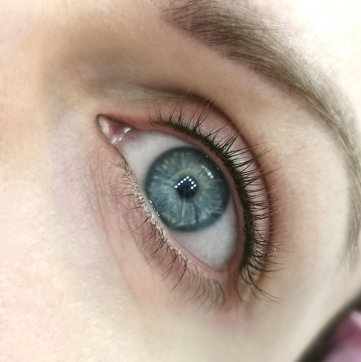 Soft Permanent infracigliare (subito dopo trattamento)