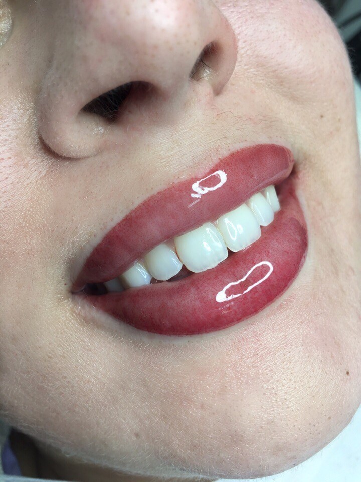 Trucco Permanente delle labbra (subbito dopo trattamento)