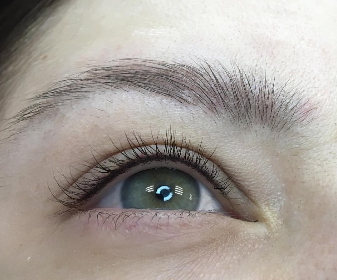 Soft Permanent infracigliare (subito dopo trattamento)